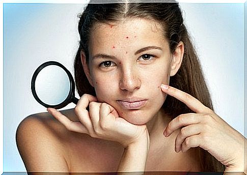 6 basic tips for expelling acne