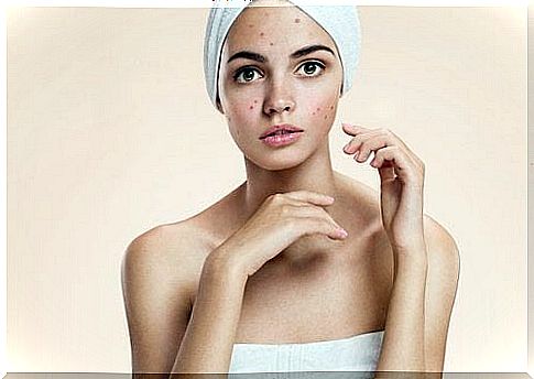 ways to banish acne