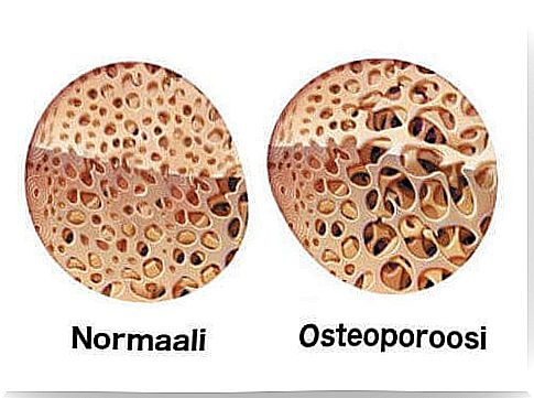 Osteoporosis weakens the bone.