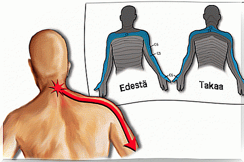 Cervicobrachial Syndrome