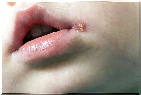 Symptoms of whooping cough are most commonly blisters and tingling in the lip