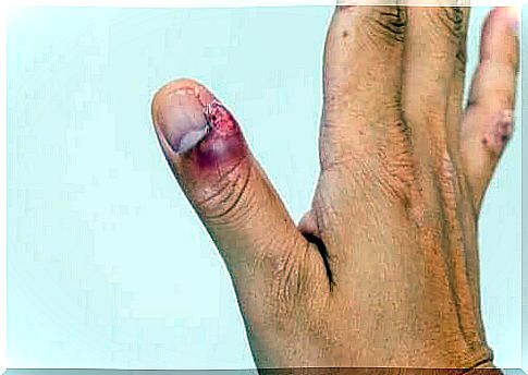 Inflammation of the nail causes redness and swelling of the skin around the nail