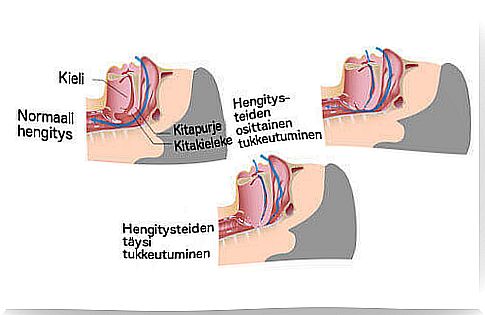 Obstructed airways