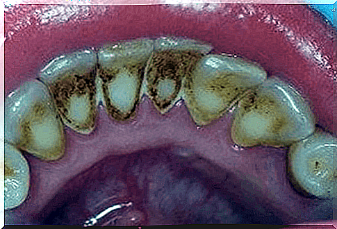 Remove plaque and improve oral hygiene