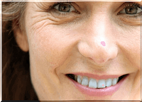 laughter and lifestyle cause wrinkles