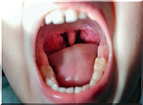 In viral pharyngitis, the pharynx may become red