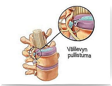 What are the symptoms of septal bulge?