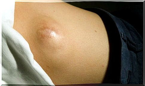 Fat patch or lipoma is a common ailment in the back, although it can also occur in the upper limbs and neck