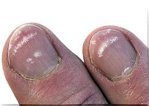 Why do white spots appear on the nails?