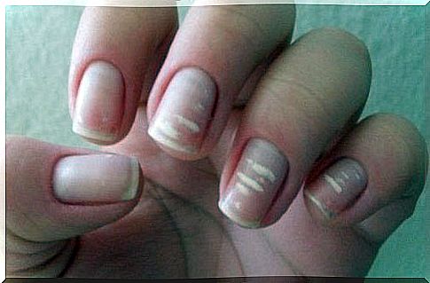 white lines on the nails